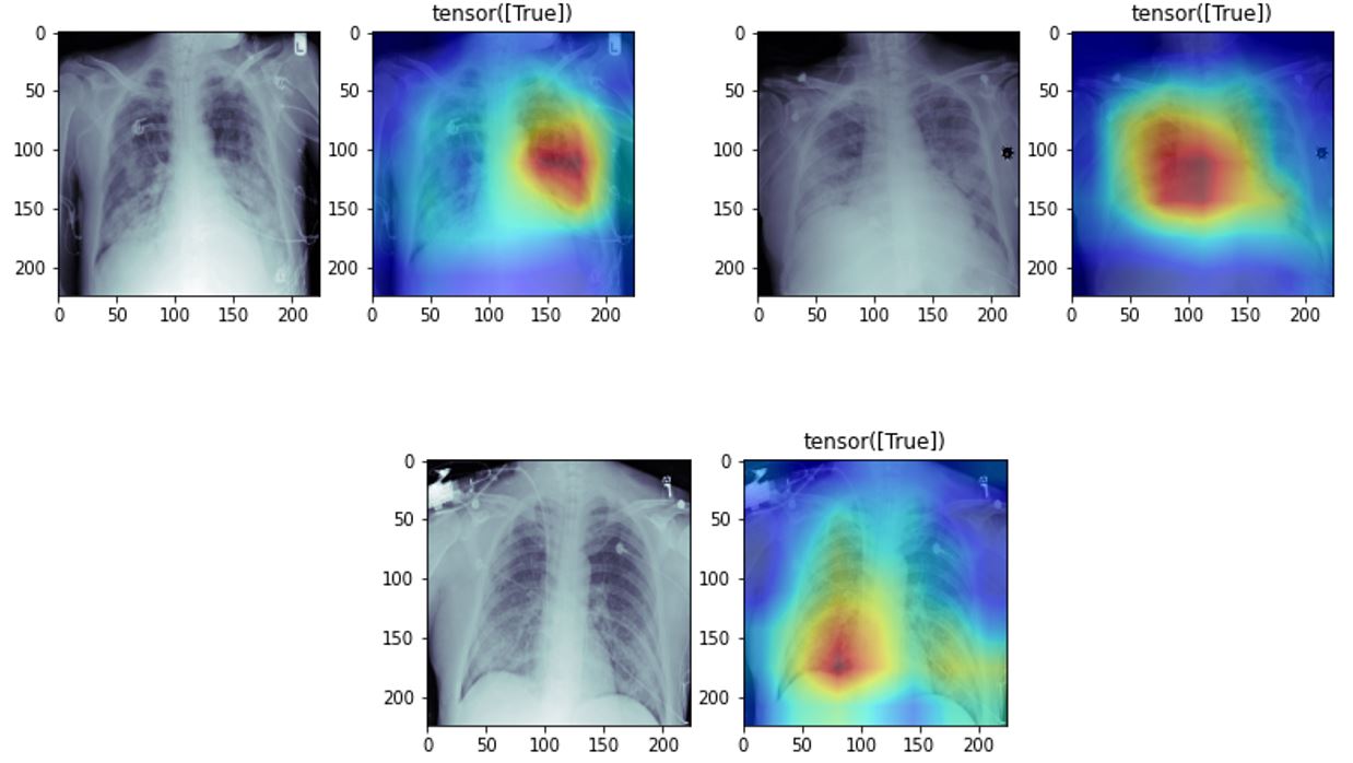 Pneumonia Classification with PyTorch